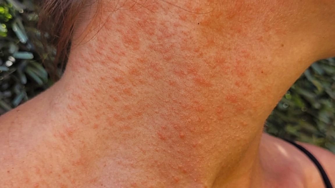 SSM llama a prevenir el sarpullido por altas temperaturas