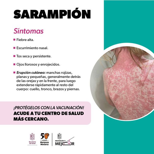 Identifica los síntomas del sarampión y protege tu salud: SSM