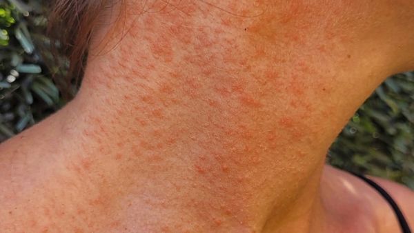 SSM llama a prevenir el sarpullido por altas temperaturas